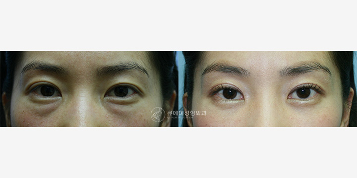 눈 밑 지방 재배치3.jpg